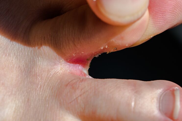 Trichophytosis