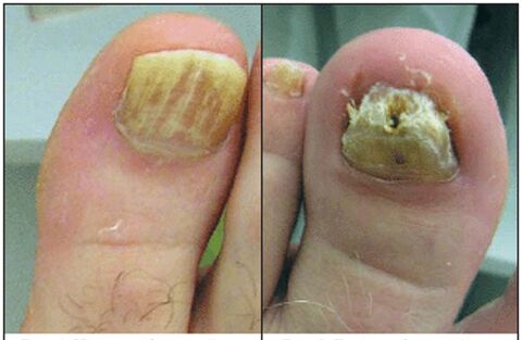 Normotrophic type of fungus