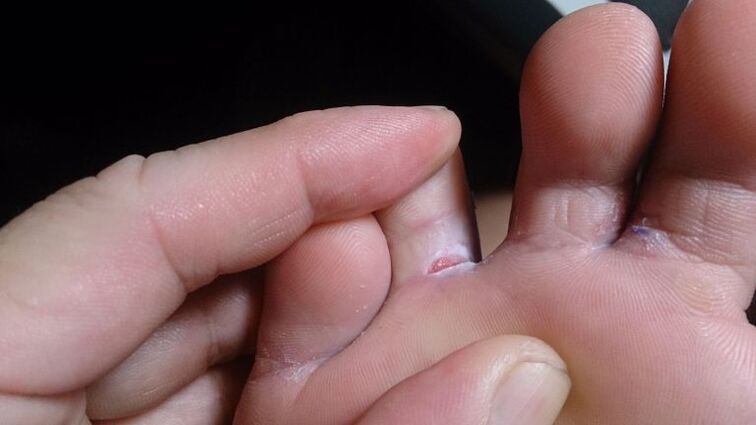 Fungus between the fingers