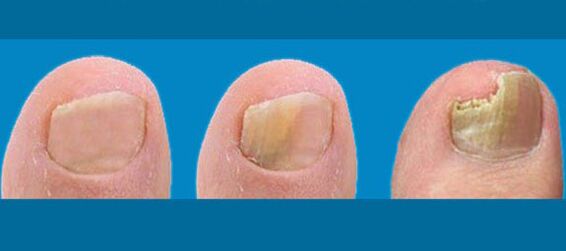 Stages of nail fungus