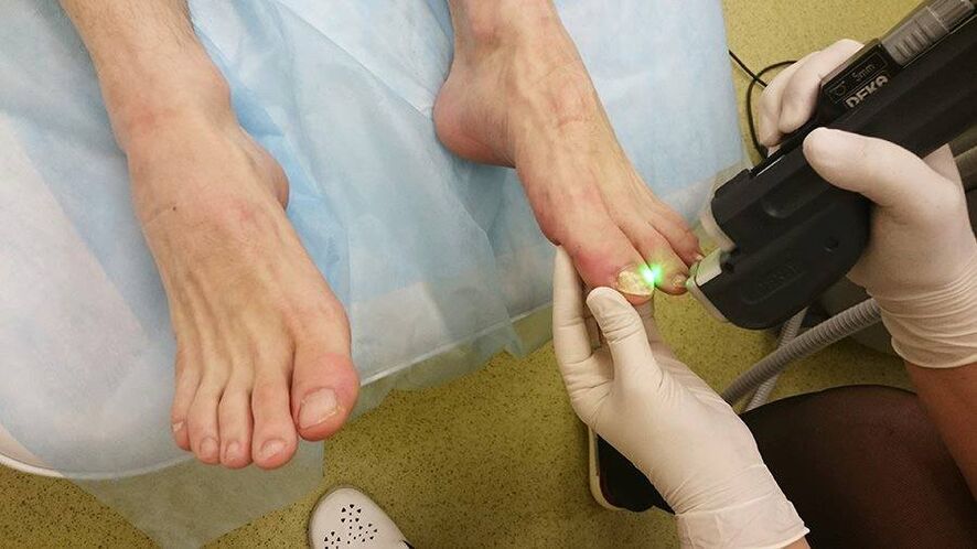 laser treatment of toenail fungus