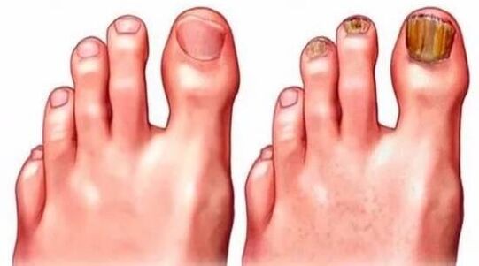 healthy nails and nails affected by fungus