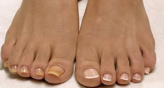 normal nails and toenail fungus