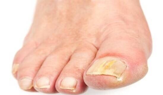 yellowing of nails due to fungal infection