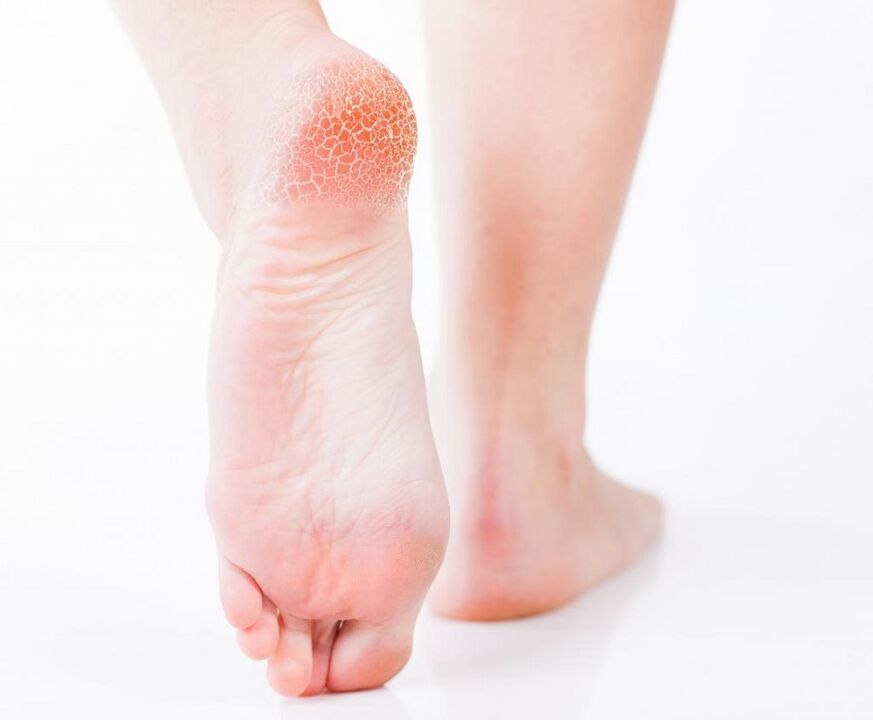 fungal infection on the foot