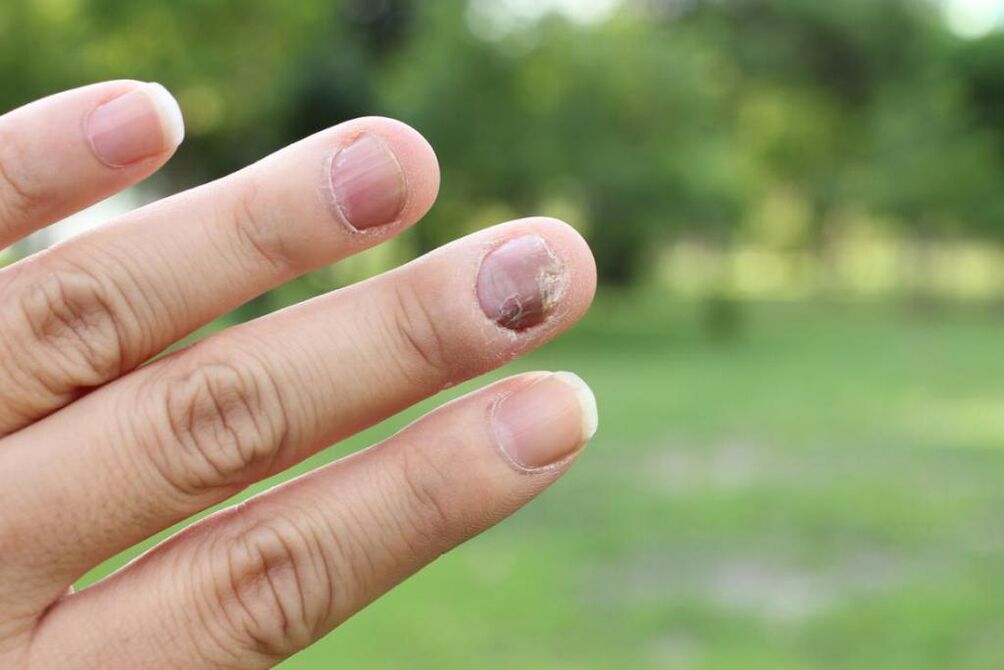 fingernail fungus