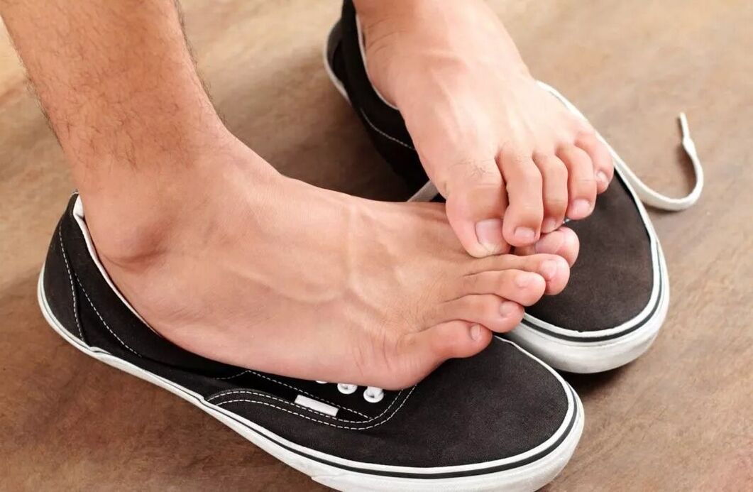 itching in the feet due to fungus between the toes