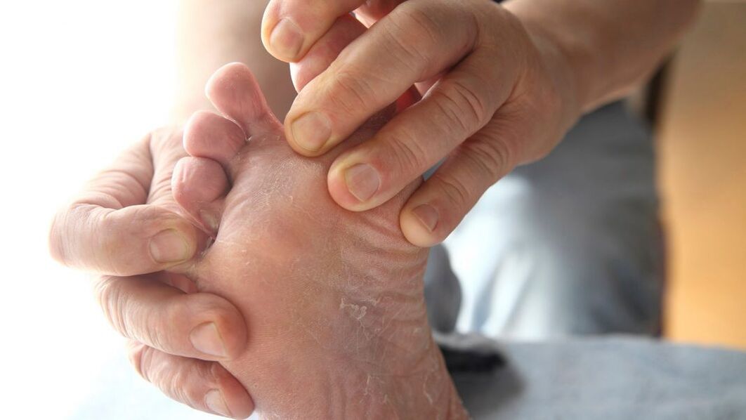 symptoms of foot fungus