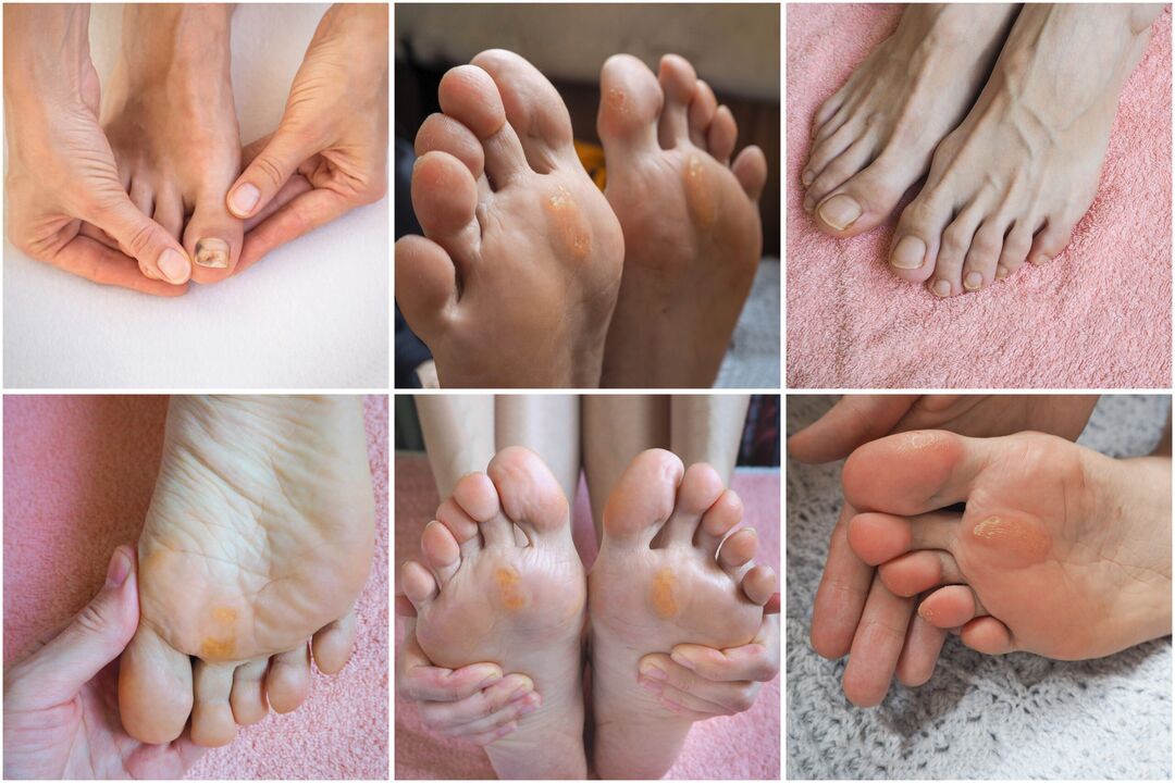 types of fungus on feet